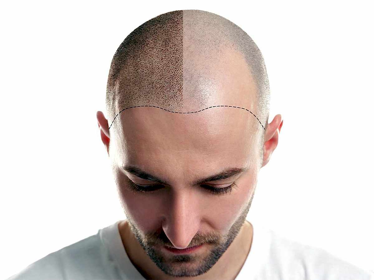 SCALP MICRO PIGMENTATION (SMP) SAÇLI GÖRÜNÜM